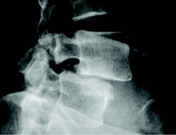 Spondylolisthesis Imaging - El Paso Chiropractor
