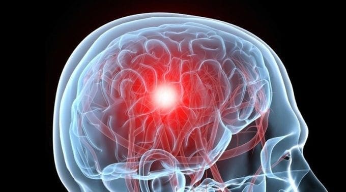 Os marcadores de sangue podían detectar con precisión o concussão