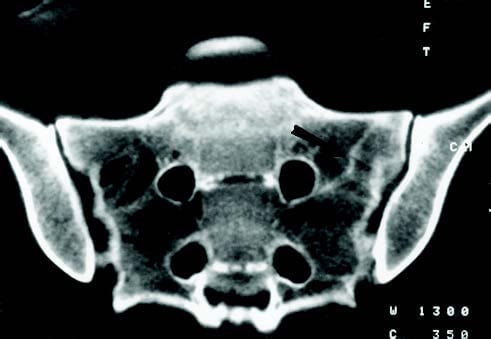 CT סריקה של שבר מתח - אל פסו Chiropractor