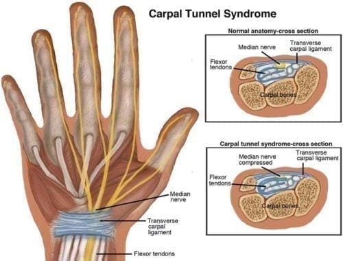 Sindrome da Tunnel Carpale - Chiropratico El Paso