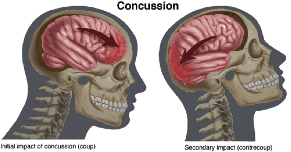 Blood Markers Could Accurately Detect Concussion