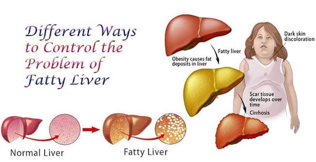 Wellness Overview: Non-Alcoholic Fatty Liver Disease - El Paso Chiropractor