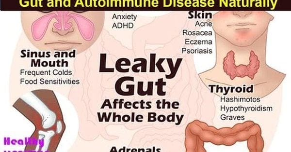 6 krokov na prirodzené vyliečenie netesného čreva a autoimunitných ochorení