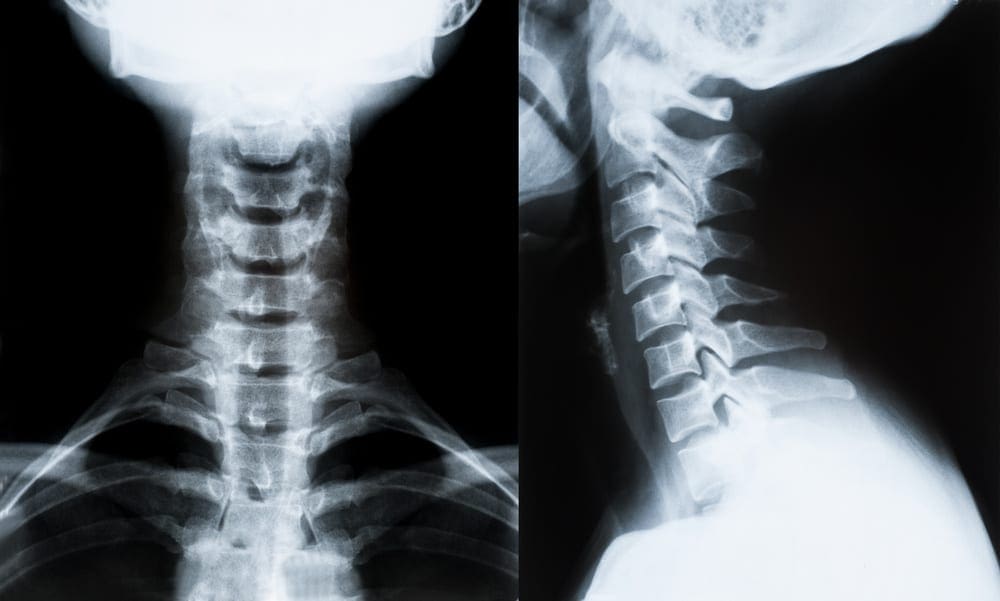 Whiplash Chiropractor: Loss of Cervical Lordosis
