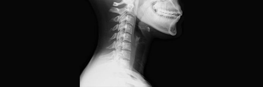 Loss of Cervical Curvature from Motor Vehicle Crashes
