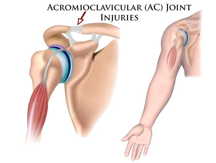 Lesioni della spalla: Il giunto Acromioclavicular (AC)