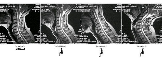 Whiplash Injury--MRI.jpg