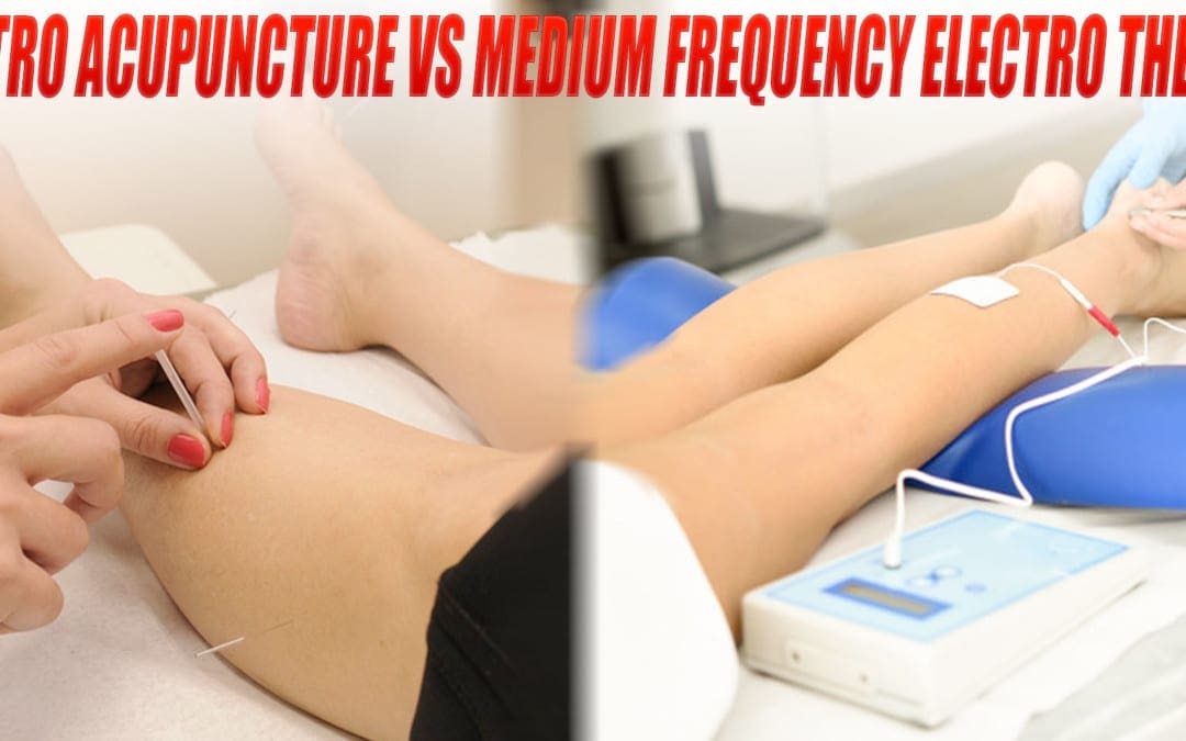 Electroacupuncture vs. Medium-Frequency Electrotherapy for Sciatica