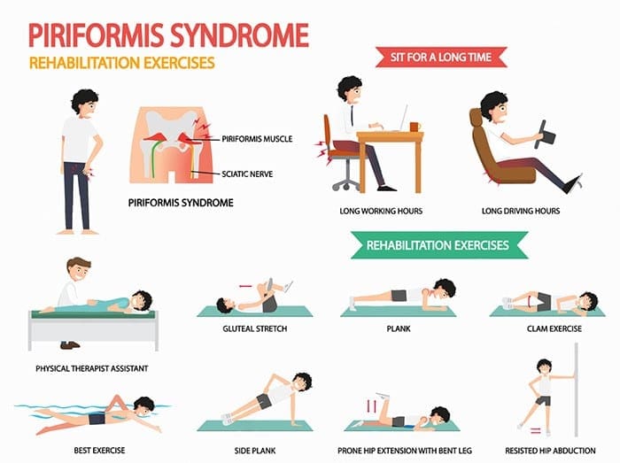 alleviare le illustrazioni di vari esercizi per la sindrome del piriforme