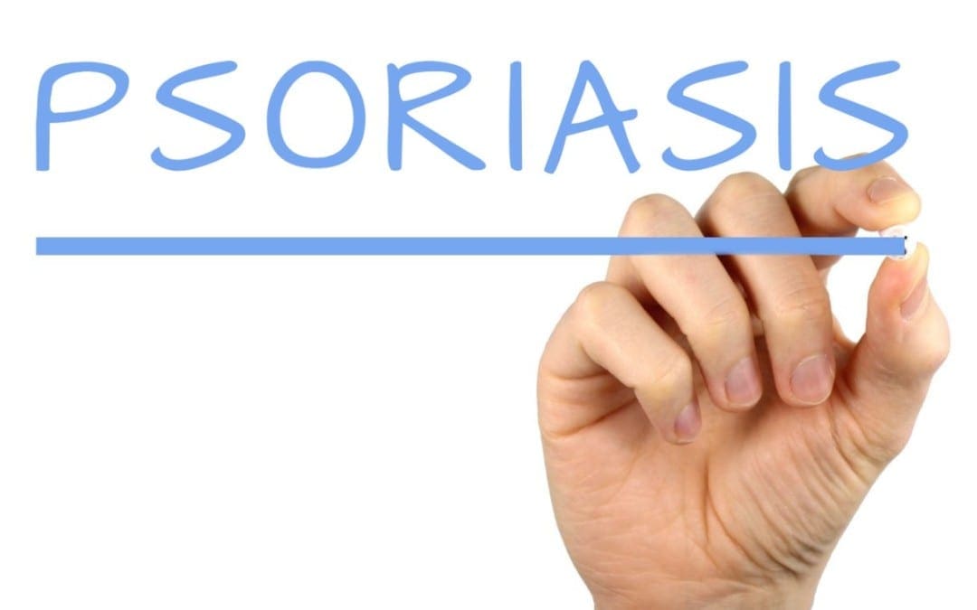Psoriasis: Tenduristî û Bijartina Alternatîf