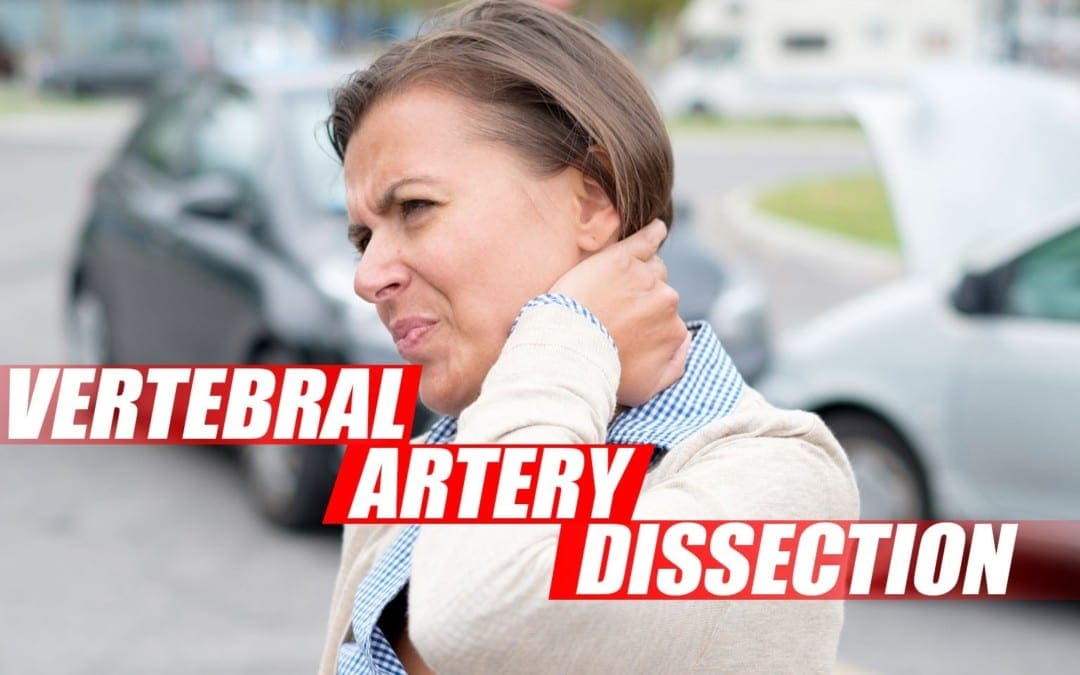 Vertebral Artery Dissection Found During Chiropractic Examination Cover Image