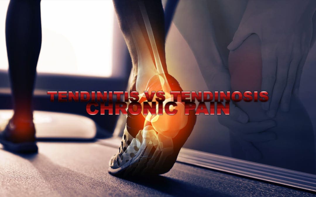 Tendinitis vs Tendinosis | Chronic Pain