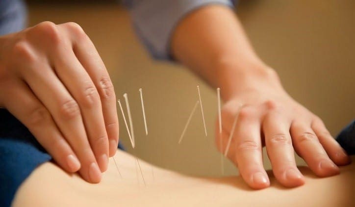 Image of an acupuncture practitioner performing acupuncture as an alternative treatment option for sciatica.