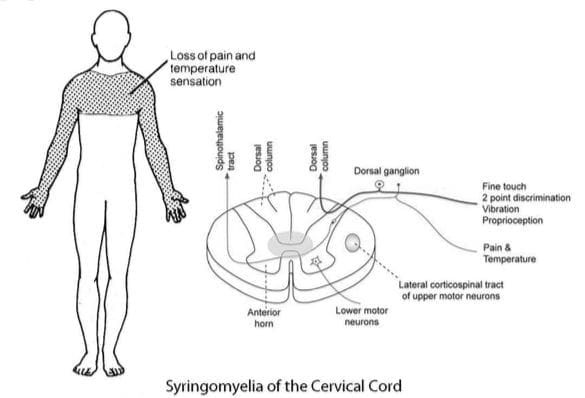 Modello di scia del capo e scialle di neuropatia | Chiropratico di El Paso, TX