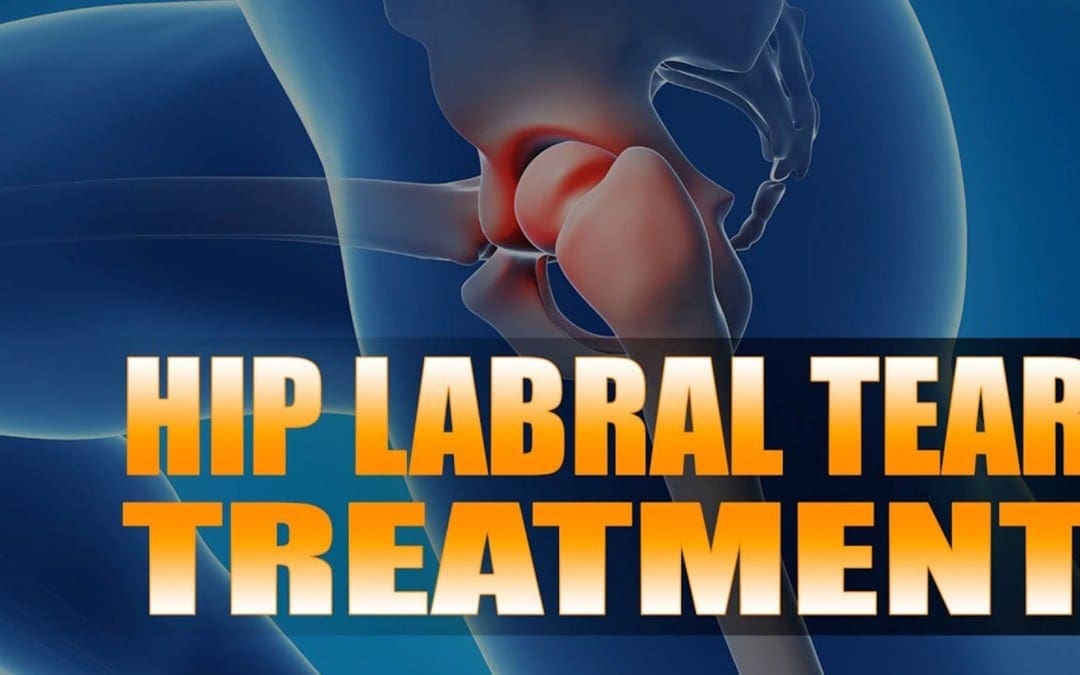 Hip Labral Tear Treatment | El Paso, TX. | Video