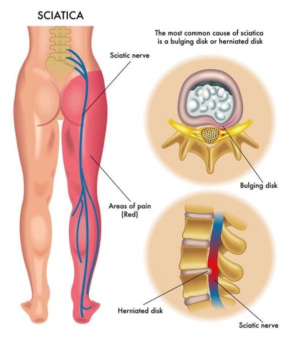 Diagrama del dolor del nervio ciático | El Quiropráctico El Paso, TX