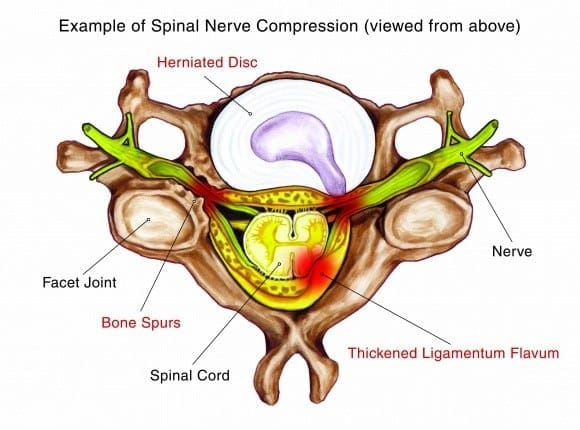 Spinal Stenosis Diagram | El Paso, TX Chiropractor