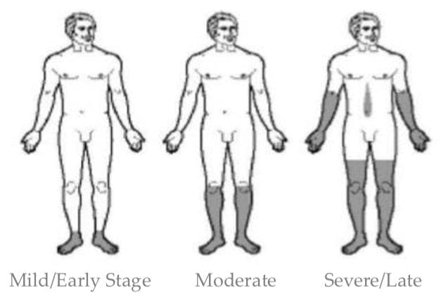 Modello di calza e guanto di neuropatia | Chiropratico di El Paso, TX