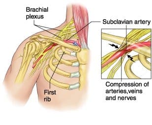 Thoracic Outlet Syndrome | El Paso, TX Chiropractor