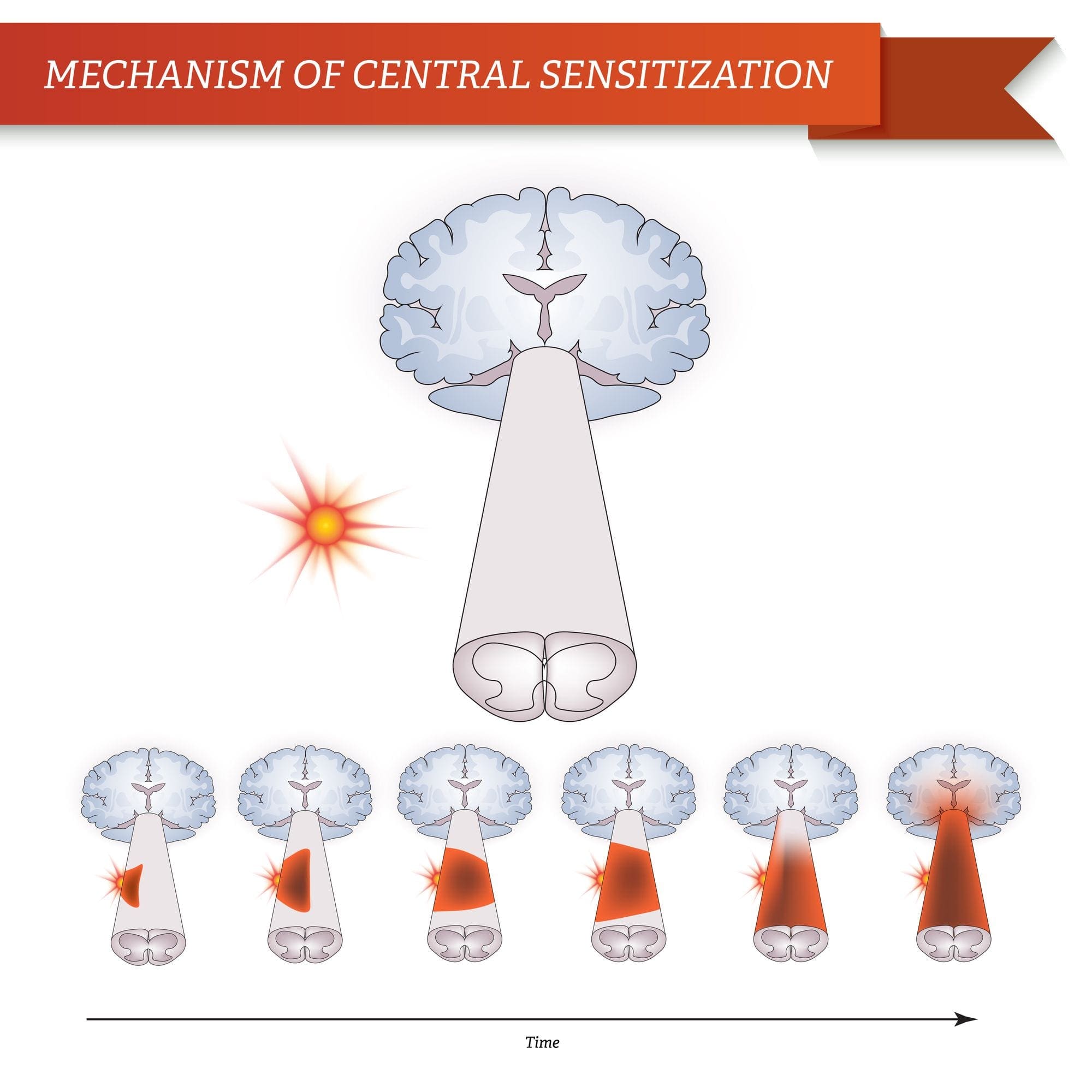 Mekanisme for central sensibilisering | El Paso, TX kiropraktor