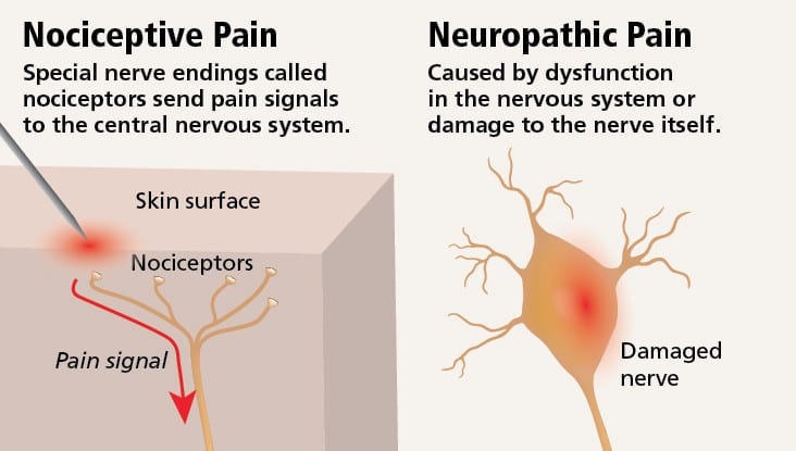 Neuropathic Pain vs Nociceptive Pain Diagram | El Paso, TX Chiropractor