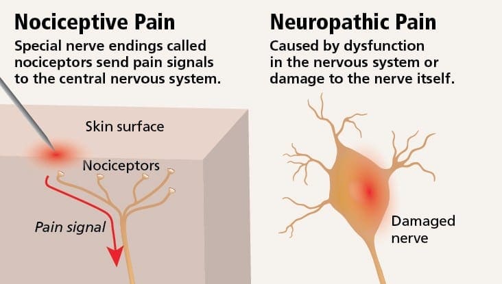 Diagram for neuropatisk smerte vs nociceptiv smerte | El Paso, TX kiropraktor