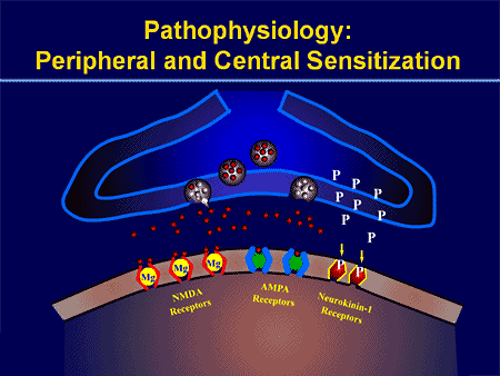 Sensitisasi Periferal dan Sentral | El Paso, TX Chiropractor