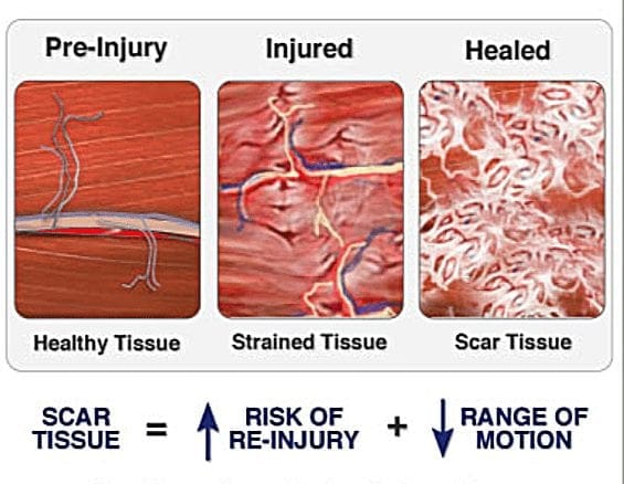 Scar Tissue Diagram 1 | El Paso, TX Chiropractor