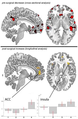 Figure 1 Statistical Parametric Maps