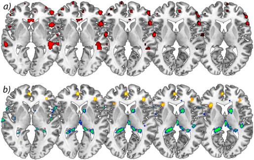 Figure 2 Increases in Brain Gray Matter