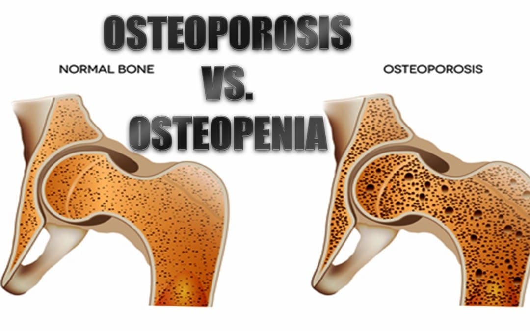 Osteoporose vs. Osteopenia: Qual é a diferença?