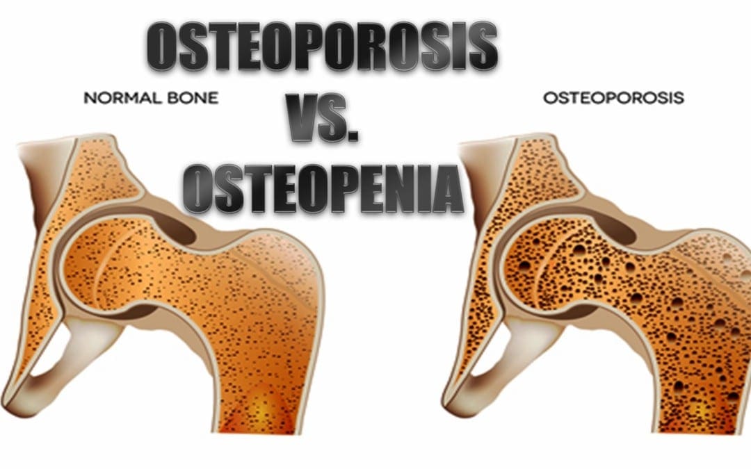 ഓസ്റ്റിയോപൊറോസിസ് vs. ഓസ്റ്റിയോപീനിയ: എന്താണ് വ്യത്യാസം?
