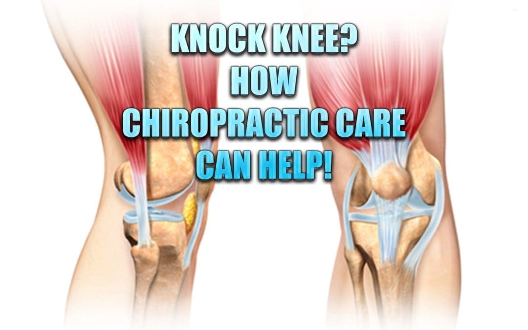 Knock Knee? La chiropratica può aiutare con questa condizione