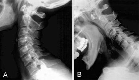 Imaging the Spine in Arthritis: una revisione pittorica