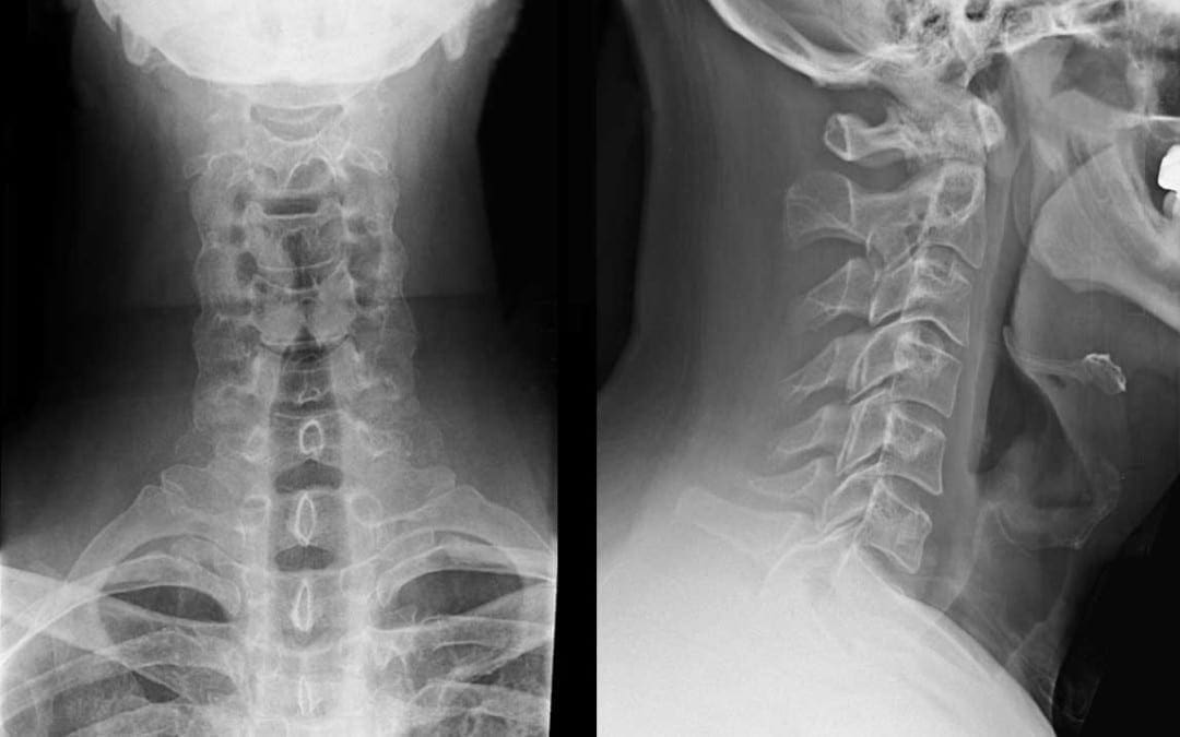 Radiografie cervicali della colonna vertebrale nel paziente traumatizzato