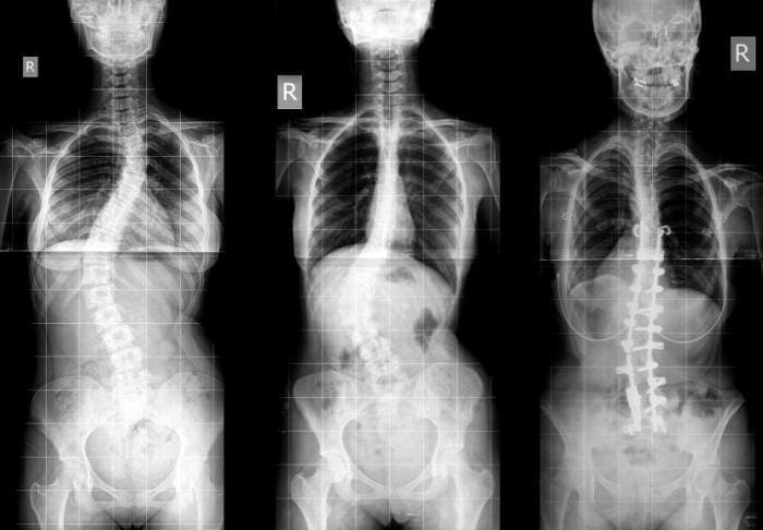 تشخیص تشخیص زودهنگام ستون فقرات تصویربرداری