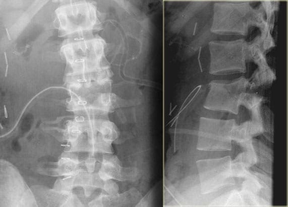 Spine Trauma Imaging Diagnostics Evaluation