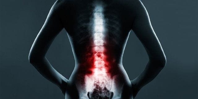 The Role of Emergency Radiology in Spinal Trauma