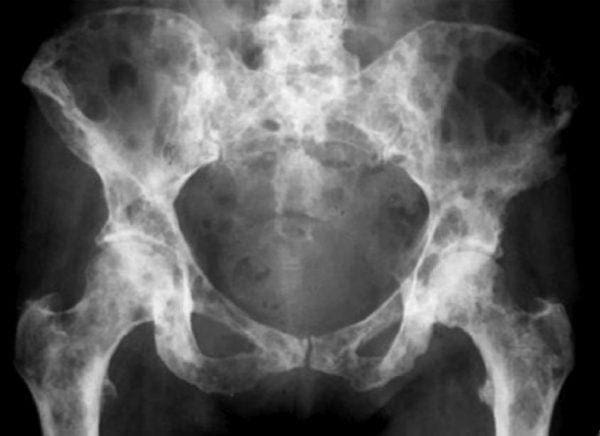 Yintoni iMatastatic Bone Disease?