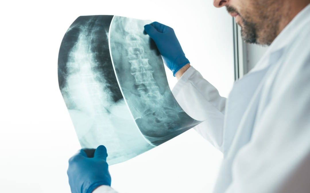 Spinal Neoplasms Diagnostic Imaging Approach Part I