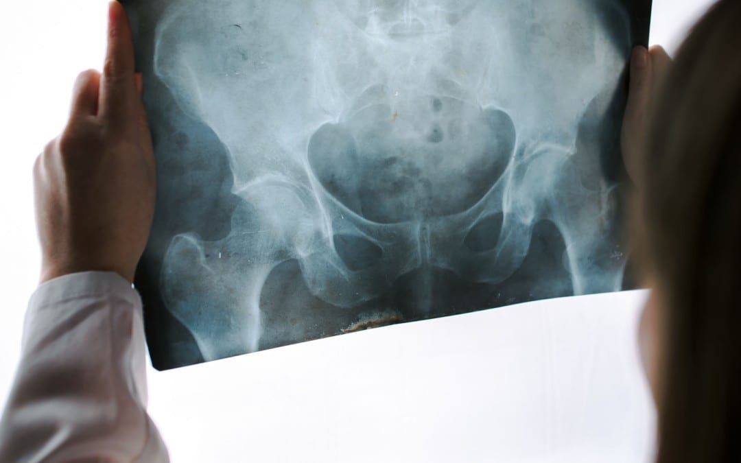 Diagnosi di recidive all'anca: artrite e neoplasie parte I | El Paso, TX.