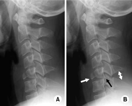 Imaging Diagnostics for Flexion Teardrop Fractures