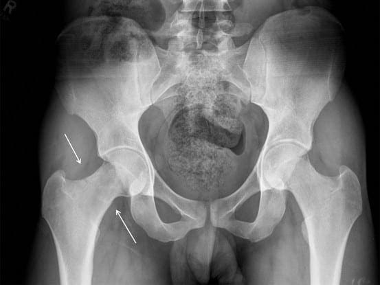 Femoral Neck Stress Fractures