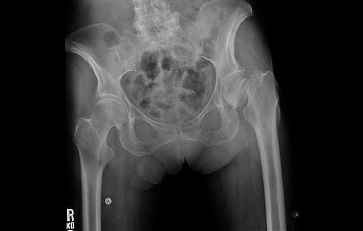 Impacted Femoral Neck Fractures