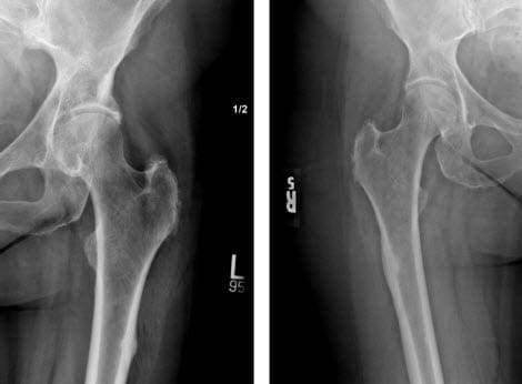 Переломи проксимального відділу стегнової кістки, пов'язані з бісфосфонатами