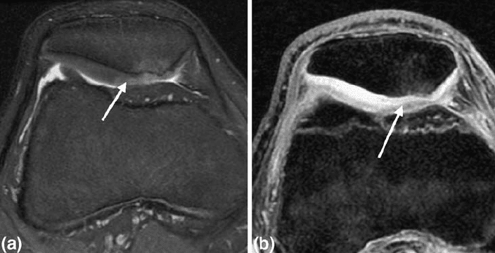 Chondromalacia Patellae дегеніміз не?