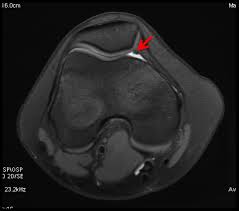 O que é a Síndrome de Knee Plica?