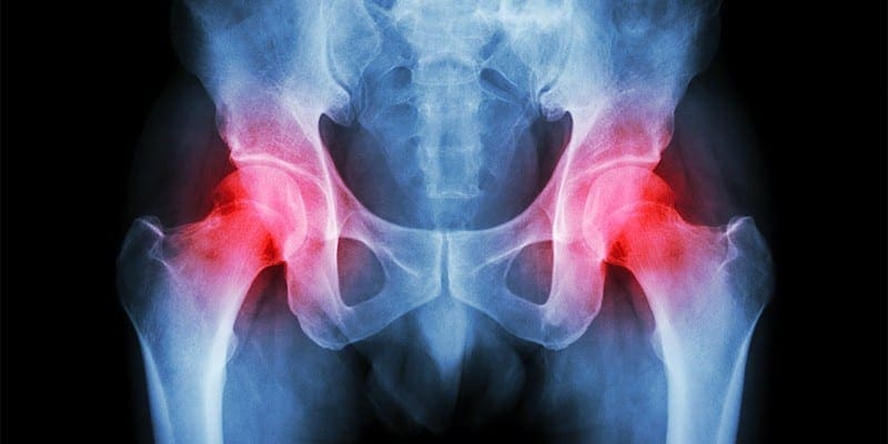 Hodnotenie pacienta s bolesťou bedrového kĺbu