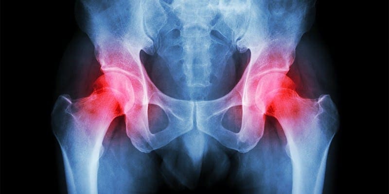 Igbeyewo ti Alaisan pẹlu Hip Pain