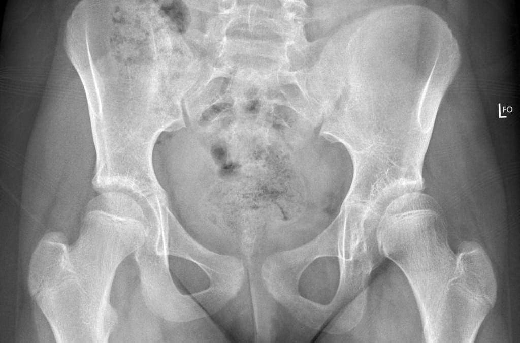 Displasia Perkembangan Hip